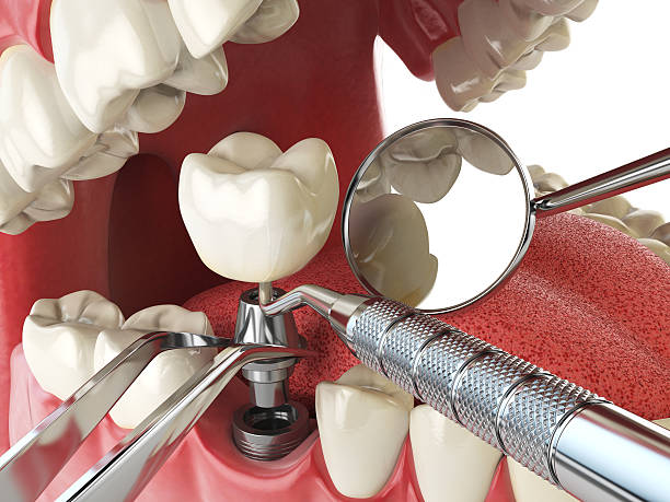 Best Emergency Broken Tooth Repair in Staples, MN